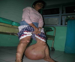 8 Penyakit Aneh Yang ada di Indonesia